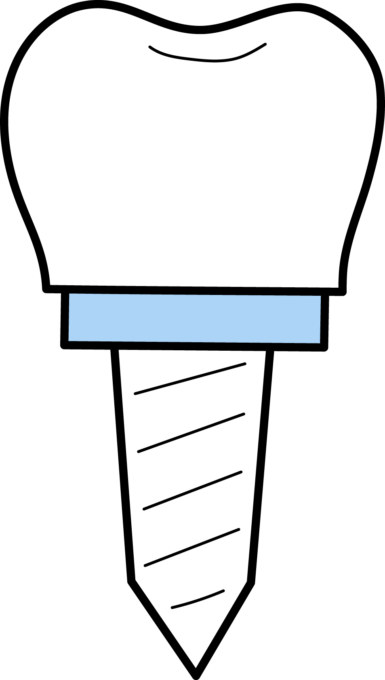 Dental Implant